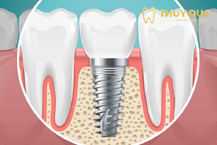 7 điều cần lưu ý trước khi trồng răng implant - Nha Khoa Thúy Đức