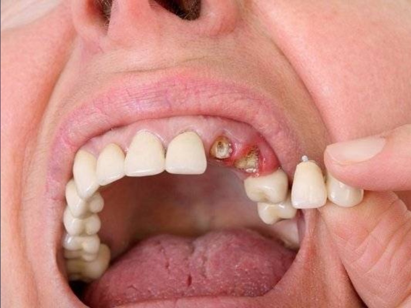 Chỉ còn chân răng có bọc sứ được không và vì sao? - Shark Dental