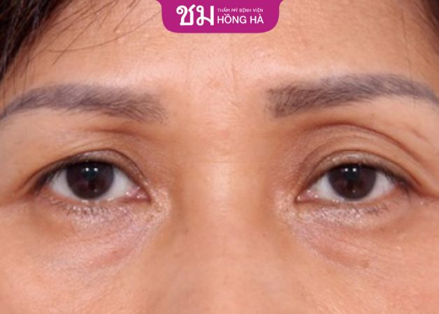 Hốc mắt sâu: Nguyên nhân và cách khắc phục giúp mắt hết trũng
