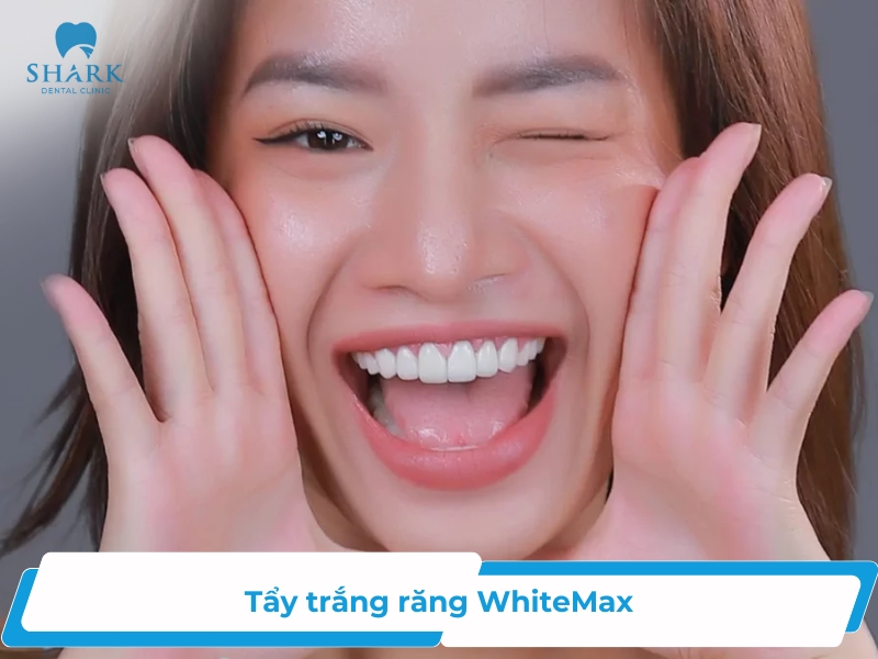 Tẩy trắng răng WhiteMax: Ưu điểm và quy trình thực hiện
